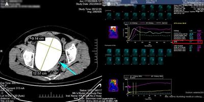 A giant neobladder stone with insignificant symptoms: A case report and literature review